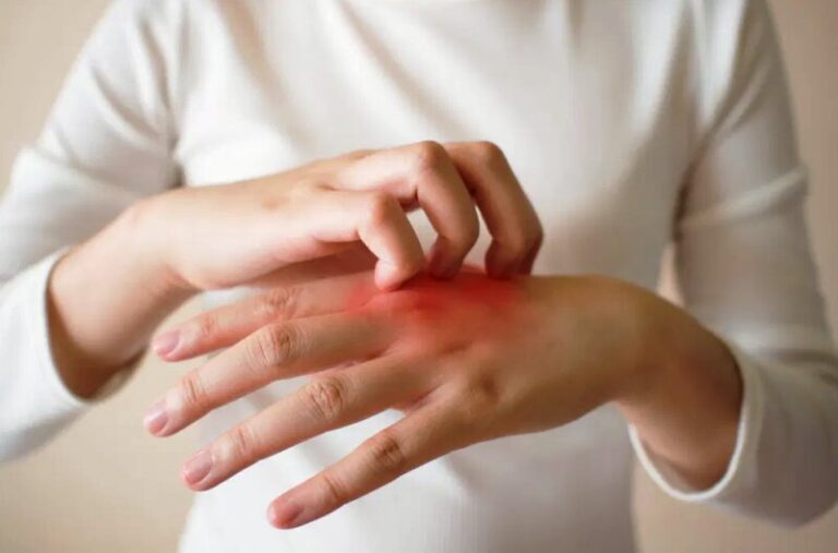 a bacterium that has a link with eczema can cause an itching reaction