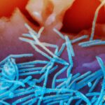 Respiratory syncytial virus connection with rare nerve disorder