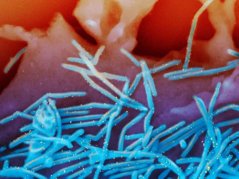 Respiratory syncytial virus connection with rare nerve disorder